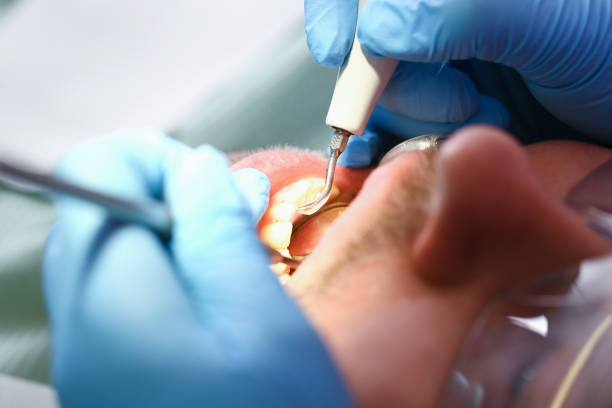Best Emergency Wisdom Teeth Removal in Pomona, KS