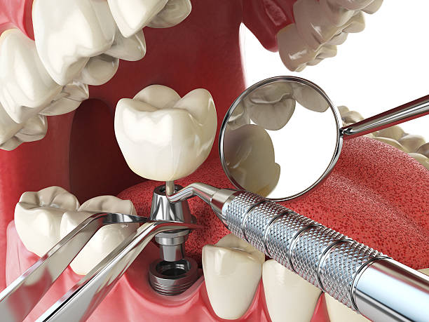 Best Emergency Root Canal Treatment in Pomona, KS